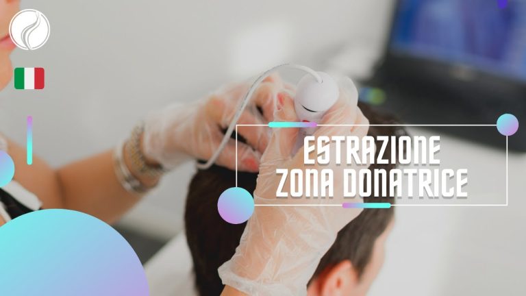 Trapianto capelli zona donatrice scarsa