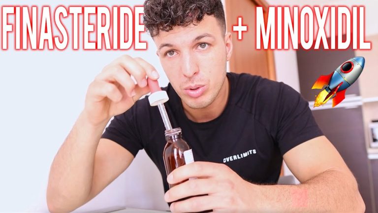 Trapianto capelli a 25 anni