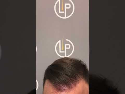 Trapianto capelli bulgaria