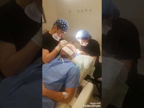 Trapianto ectopico capelli