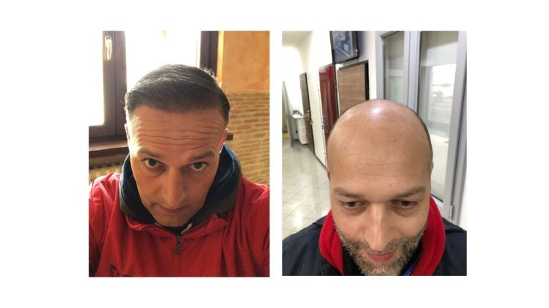 Stefano buttafuoco trapianto capelli