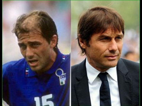 Trapianto capelli conte hasson