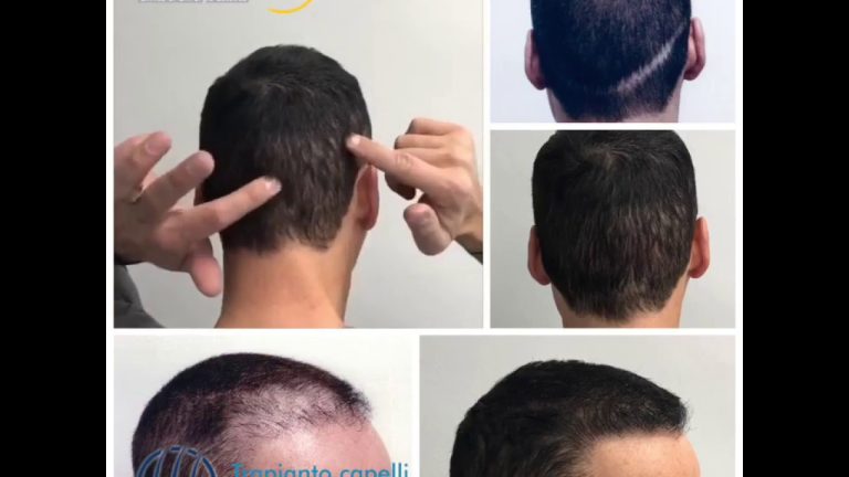 Wong trapianto capelli
