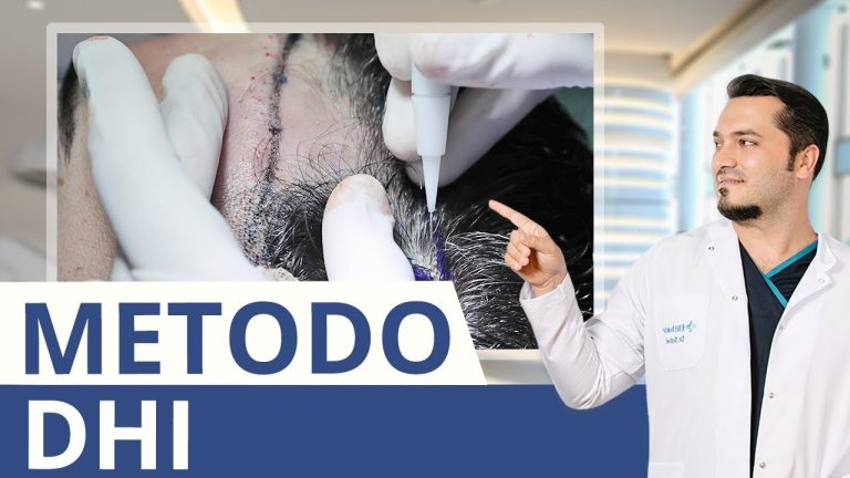 Trapianto capelli senza rasare