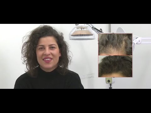 Donne che hanno fatto il trapianto di capelli