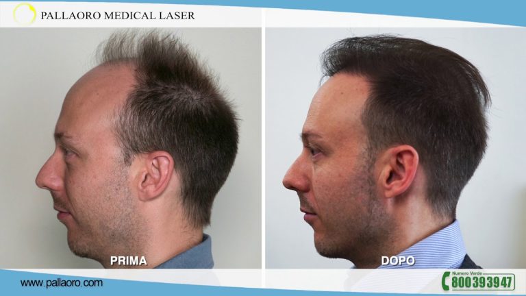 Pallaoro trapianto capelli pareri