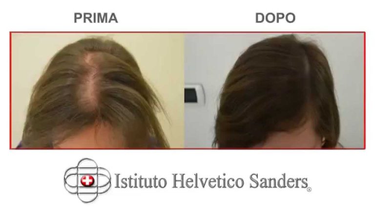 Trapianto capelli donne esperienze