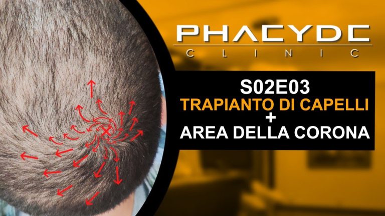 Basoccu trapianto capelli