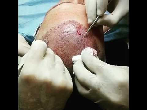 Trapianto capelli su tessuto cicatriziale