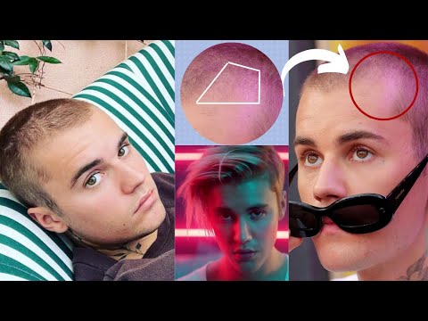 Ha Justin Bieber Fatto un Trapianto di Capelli?