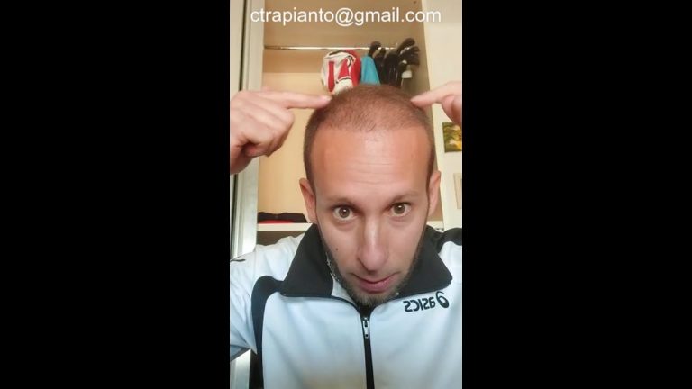 Claudio Baglioni ha subito un trapianto di capelli? Scopri la verit&agrave;!