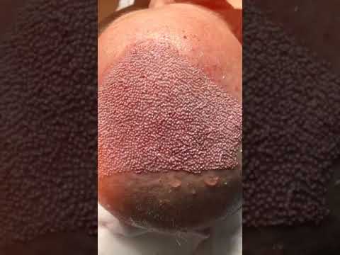 Cosa sai sul Trapianto di Capelli di Michelangelo?
